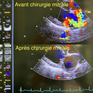 avant / après chirurgie mitrale